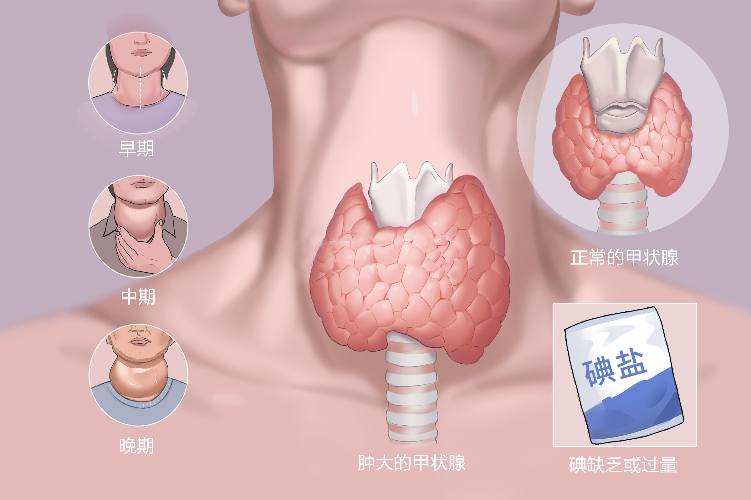 单纯甲状腺肿