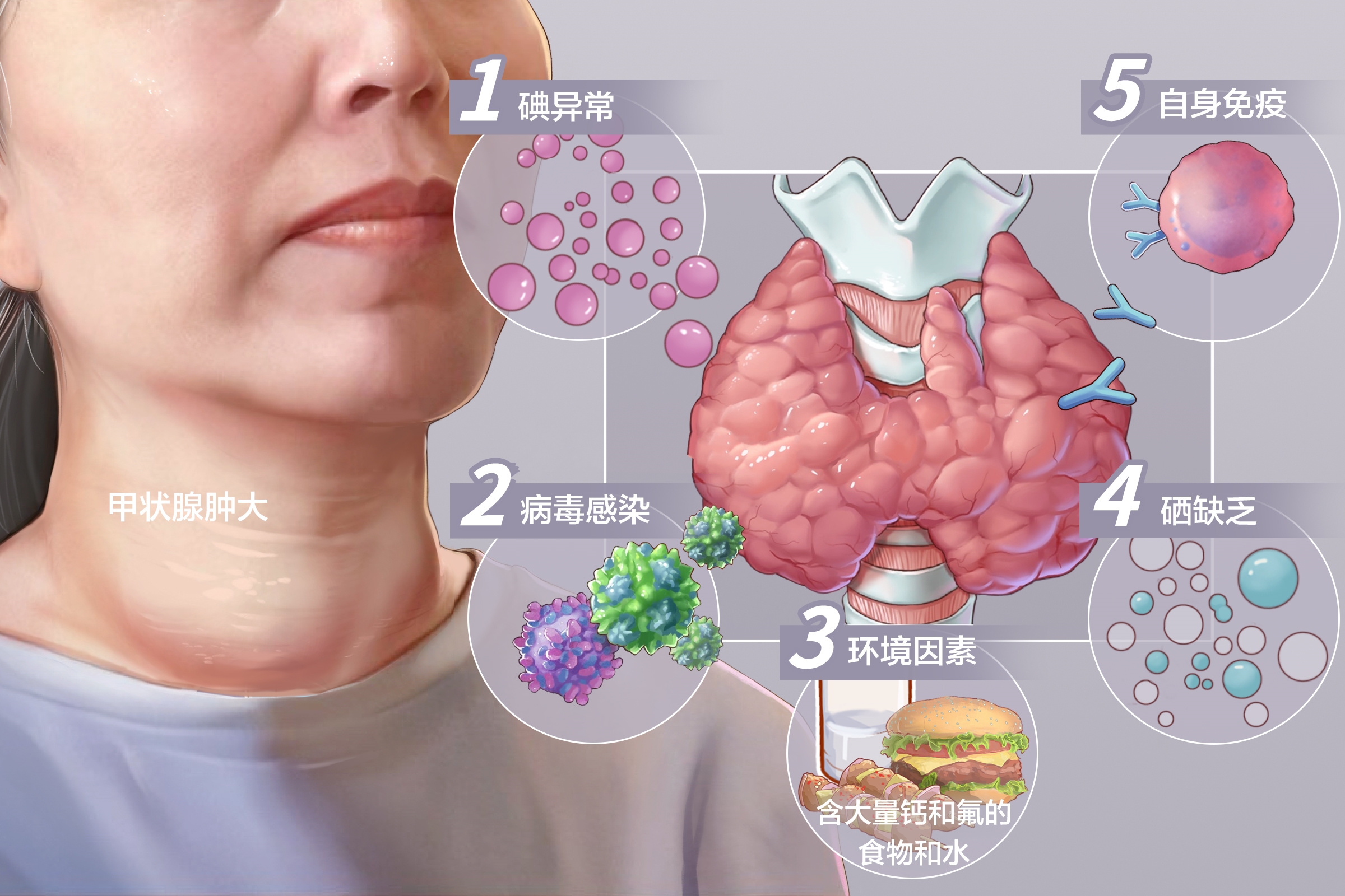 甲状腺肿大